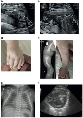 Case Report: Stüve–Wiedemann syndrome—a rare cause of persistent pulmonary hypertension of the newborn